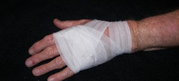 Case Study – Burn to Arm Caused by Defective Machinery